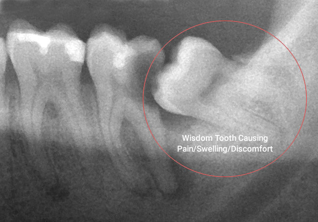 Wisdom Tooth Removal